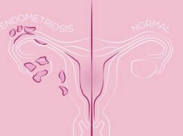 Endometriosis Myths: Understanding The Basics Of An Under-Diagnosed Condition